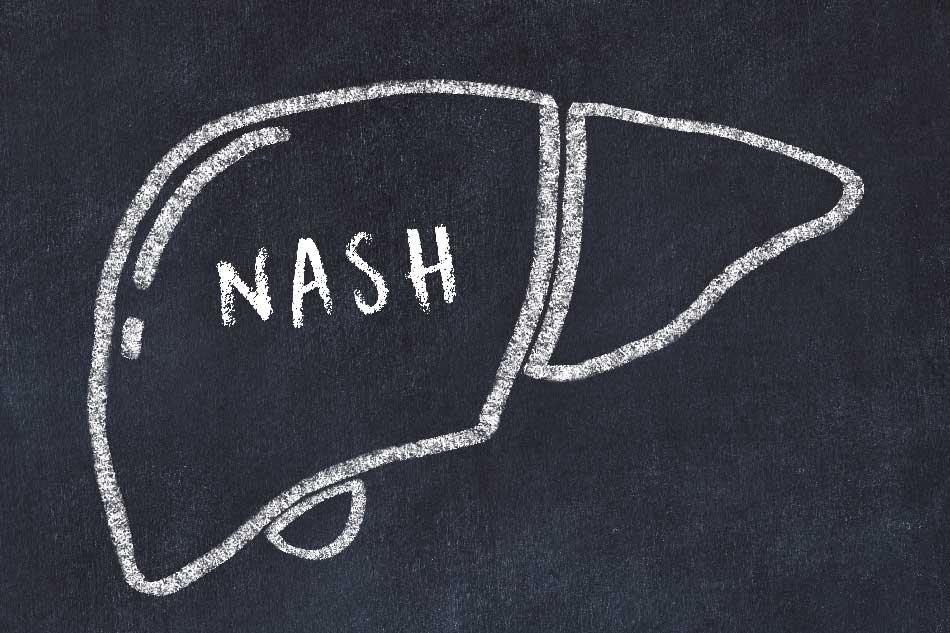 NASH: steatoepatite non alcolica