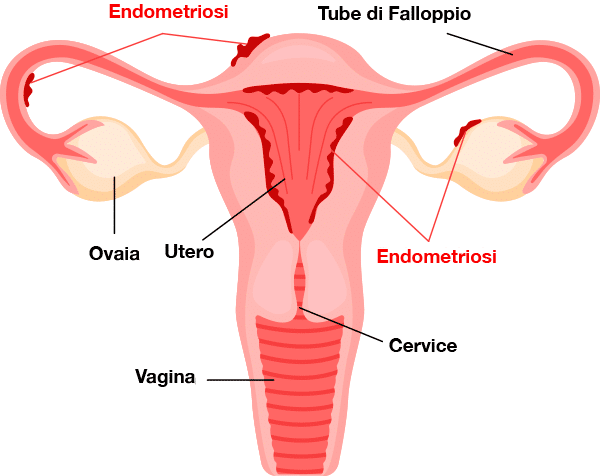 sedi comuni dell'endometriosi
